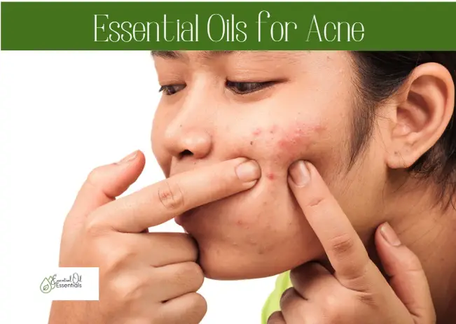 6 Best Essential Oils for Acne in 2022