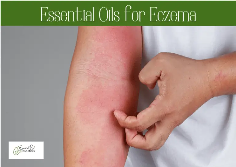 essential oils for eczema